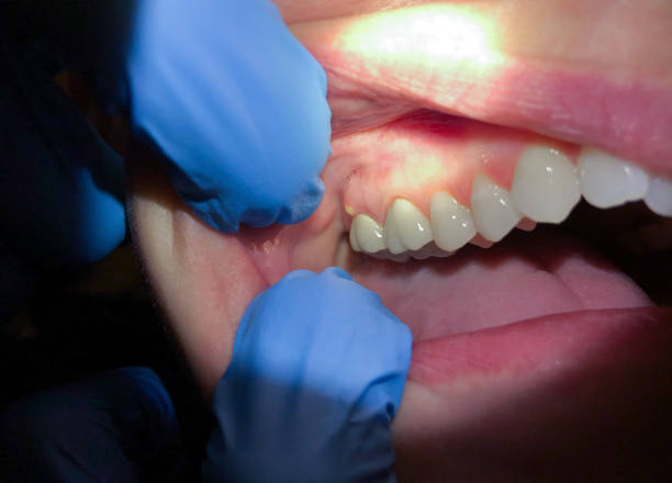Best Knocked-Out Tooth (Avulsed Tooth) Treatment in Seaford, NY